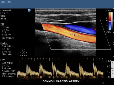 Farbdublexsonographie: Ultraschalluntersuchung der Halsgefäße