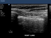 Pleurasonographie Ultraschalluntersuchung des Rippenfellraums